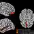 Imagem mostra cinco cérebros computadorizados ao comparar cérebros de quem teve e quem não teve covid-19