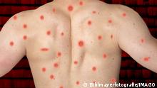 06 July 2022: monkey pox, monkey pox rash on the bare back of a young man PHOTOMONTAGE *** Affenpocken, Affen Pocken Ausschlag auf dem nackten Rücken von einem jungen Mann FOTOMONTAGE 