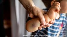 Thema: Kindesmisshandlung. Haematom am Arm eines Kindes. || Modellfreigabe vorhanden