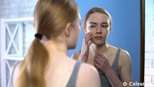 Unhappy teenage girl with face acne looking in mirror, hormonal skin problems