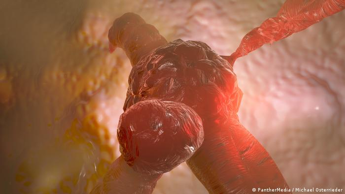Científicos descubren las células malignas responsables de la recaída en el cáncer de colon 