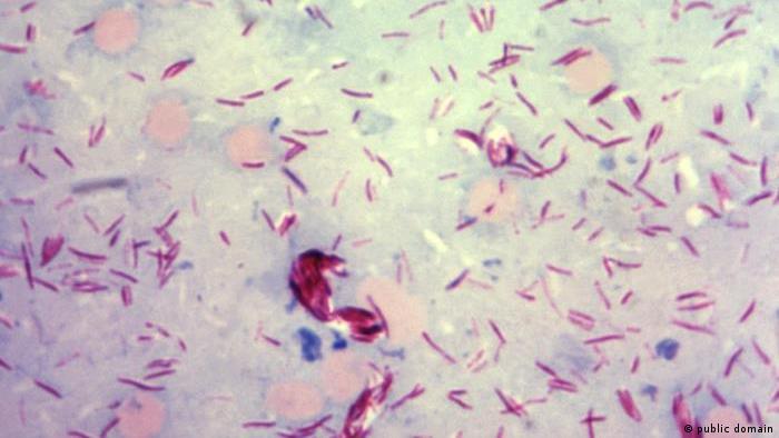 La bacteria Mycobacterium leprae en una muestra de frotis cutáneo