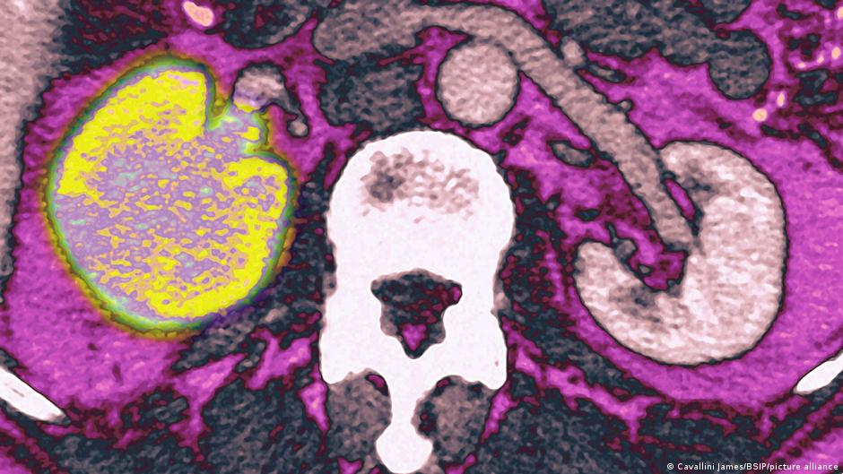 Lancet Oncology: Votrient and Avastin show 63.2-month median survival