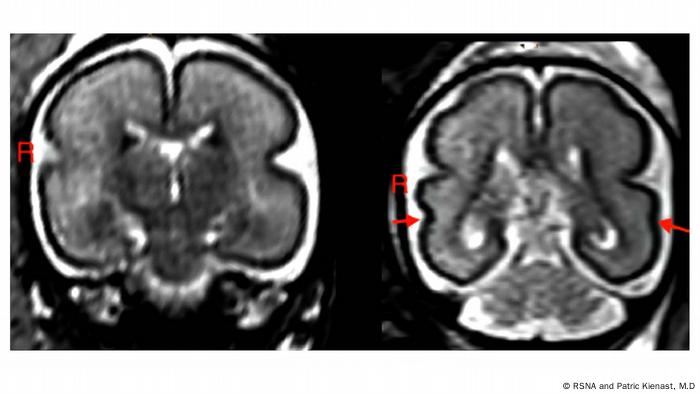 Comparación de un cerebro fetal tras la exposición al alcohol intrauterino en un feto de entre 25 y 29 semanas de gestación y un caso de control sano emparejado.
