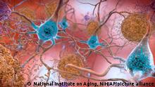 This illustration made available by the National Institute on Aging/National Institutes of Health depicts cells in an Alzheimerâ€™s affected brain, with abnormal levels of the beta-amyloid protein clumping together to form plaques, brown, that collect between neurons and disrupt cell function. Abnormal collections of the tau protein accumulate and form tangles, blue, within neurons, harming synaptic communication between nerve cells. An experimental Alzheimerâ€™s drug modestly slowed the brain diseaseâ€™s inevitable worsening, researchers reported Tuesday, Nov. 29, 2022 - and the next question is how much difference that might make in peopleâ€™s lives. Japanese drugmaker Eisai and its U.S. partner Biogen had announced earlier this fall that the drug lecanemab appeared to work, a badly needed bright spot after repeated disappointments in the quest for better Alzheimerâ€™s treatments. (National Institute on Aging, NIH via AP)