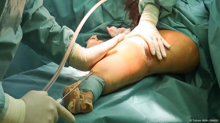 Surgery to remove lipedema - tube is inserted into lower leg