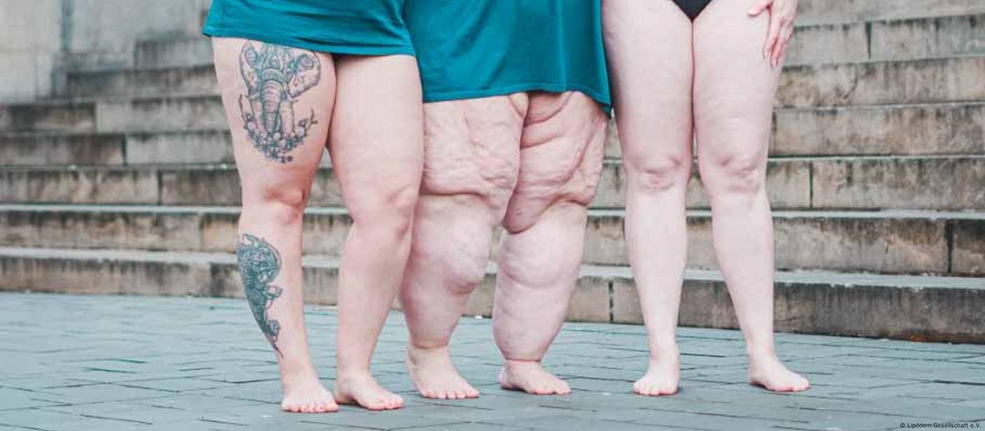 Lipedema is not the same as obesity – DW – 01/04/2023