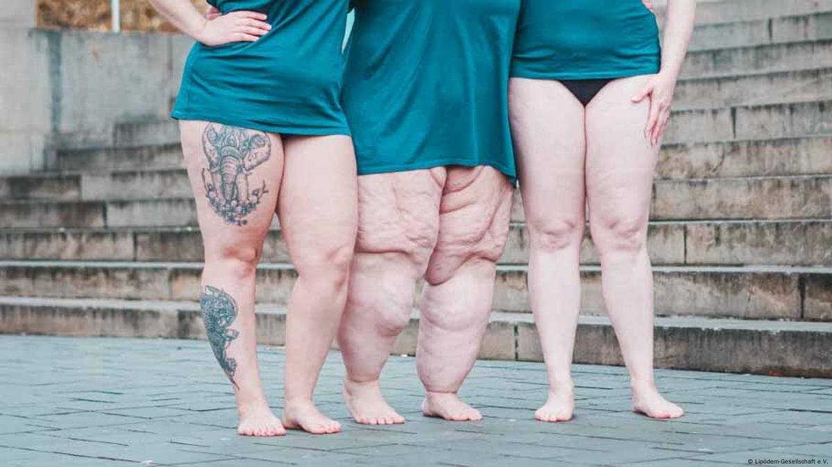 Lipedema nada tem a ver com obesidade ou má nutrição – DW – 08/01/2023