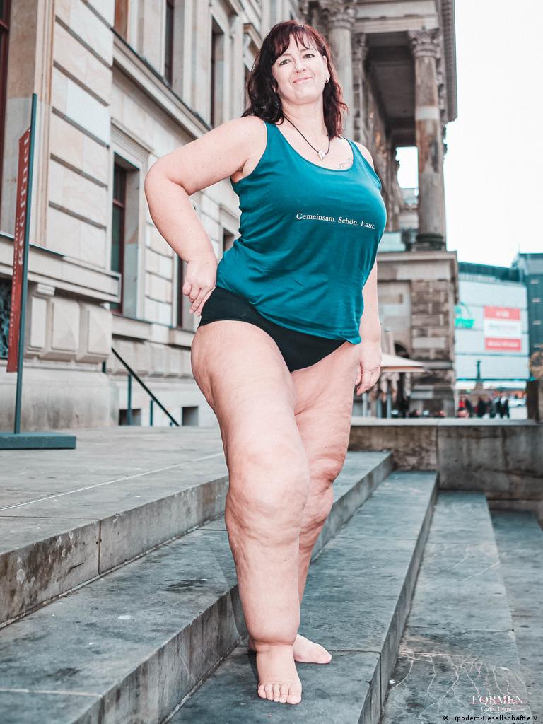 Lipedema Can Cause Disfiguring Fat Deposits In Women : Shots - Health News  : NPR