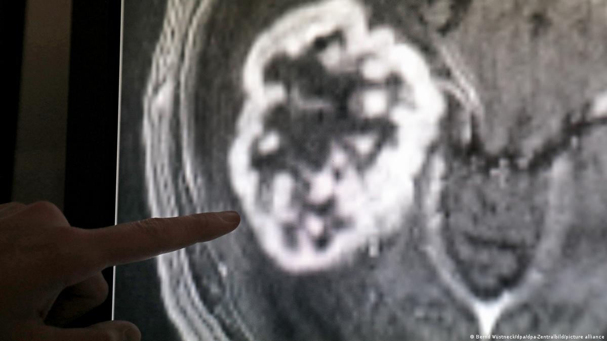 Aumenta el cáncer entre adultos jóvenes en el mundo