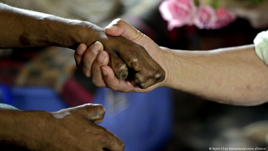 Welt-Lepra-Tag-Krankheit-ist-l-ngst-nicht-bezwungen