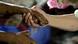 Hand eines Lepra-Patienten (links) Hand eines Lepra-Patienten (links)