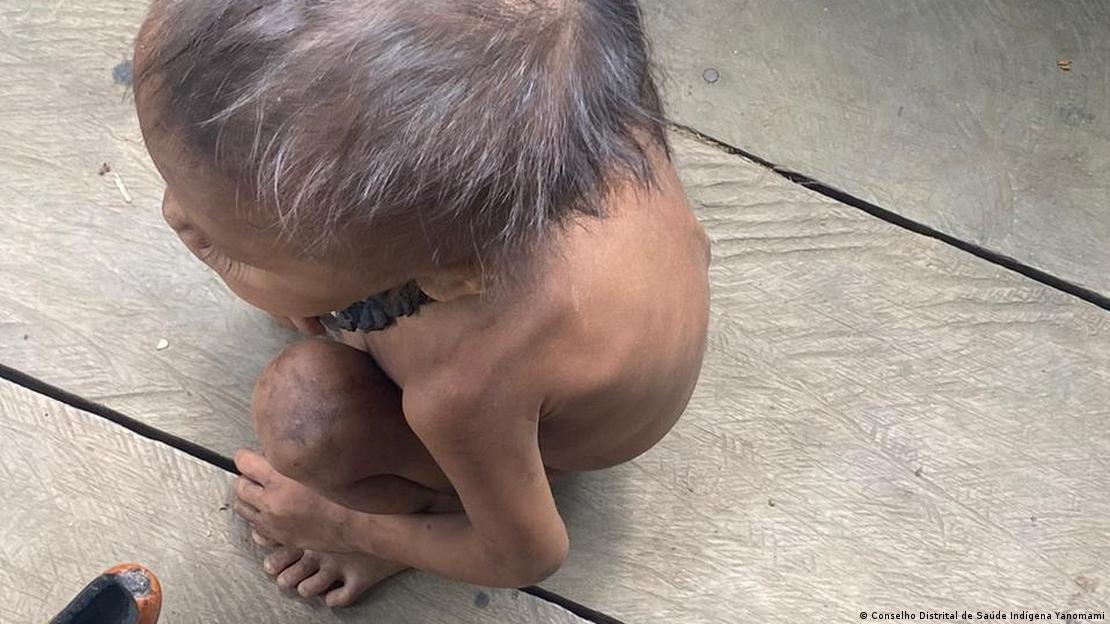 Criança yanomami sentada no chão e fotografada de cima, com braços e pernas muito magros, com quadro de desnutrição em polo de saúde de Surucucu, em Roraima