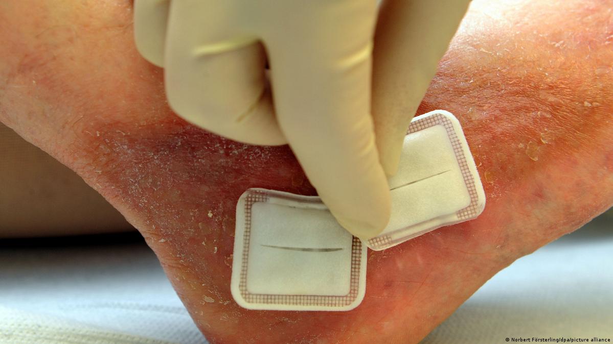 La larvaterapia ayuda a acelerar la cicatrización de heridas DW 13