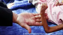 SANAA, YEMEN - DECEMBER 13: A Yemeni child, suffering from malnutrition, receives treatment with limited resources in the Department of Combating Malnutrition at Sabeen Hospital in Sanaa, Yemen on December 13, 2022. Millions of people will face hunger unless urgent action is taken in Yemen, which is in the grip of a humanitarian crisis brought on by a civil war that has lasted more than seven years, according to the United Nations Children's Fund (UNICEF). Mohammed Hamoud / Anadolu Agency