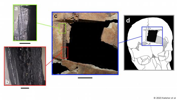 Evidencia de trepanación.