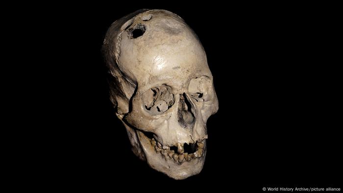 Cráneo con evidencia de trepanación.