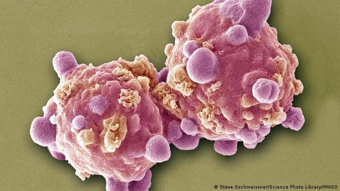 Células de leucemia vistas en una micrografía electrónica de barrido coloreada (SEM).
