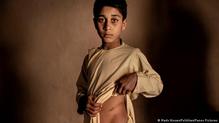 Niño muestra su cicatriz en el estómago, en Afganistán.  Mads Nissen, World Press Photo (World Press Photo) 2023: El precio de la paz en Afganistán.