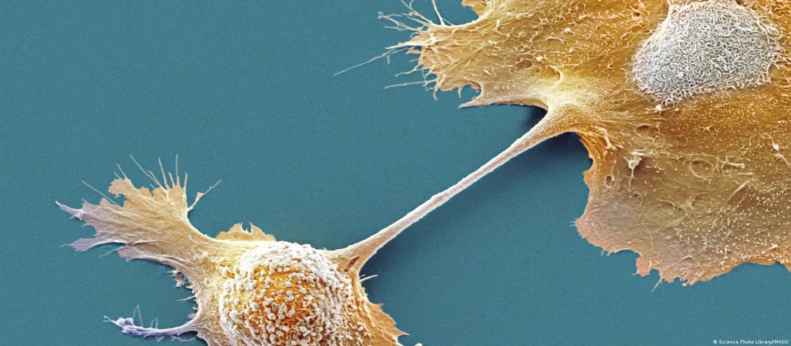 Píldora casi duplica la supervivencia en cáncer de páncreas