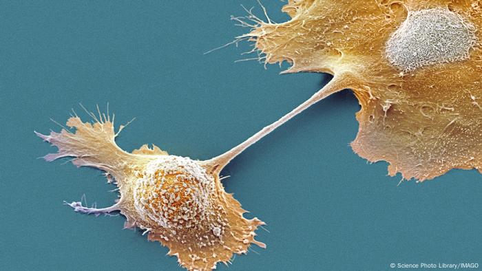  Células de cáncer de páncreas en el microscopio electrónico de barrido.