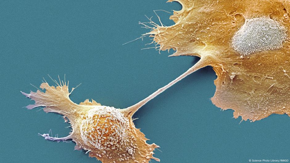 Scientists find promising pancreatic cancer leads DW 02/25/2025