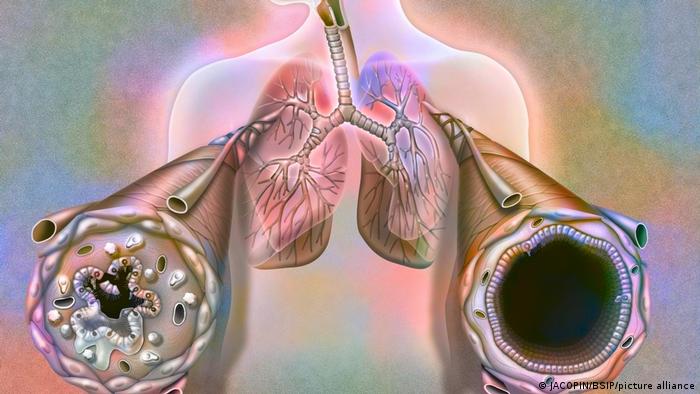 Zustand der Bronchien während und nach einem Asthma-Anfall - Computerbild 