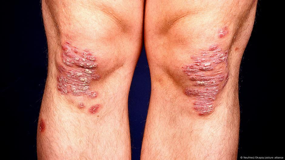 Kolena su jedan od tipičnih delova tela na kojima se javlja psorijaza