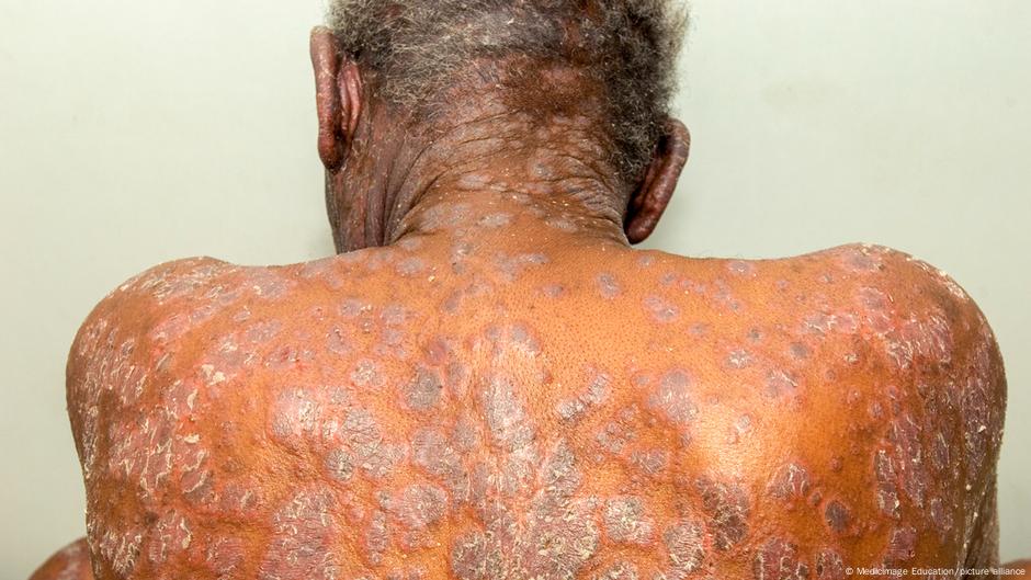 U teškim slučajevima zahvaćene su velike površine kože