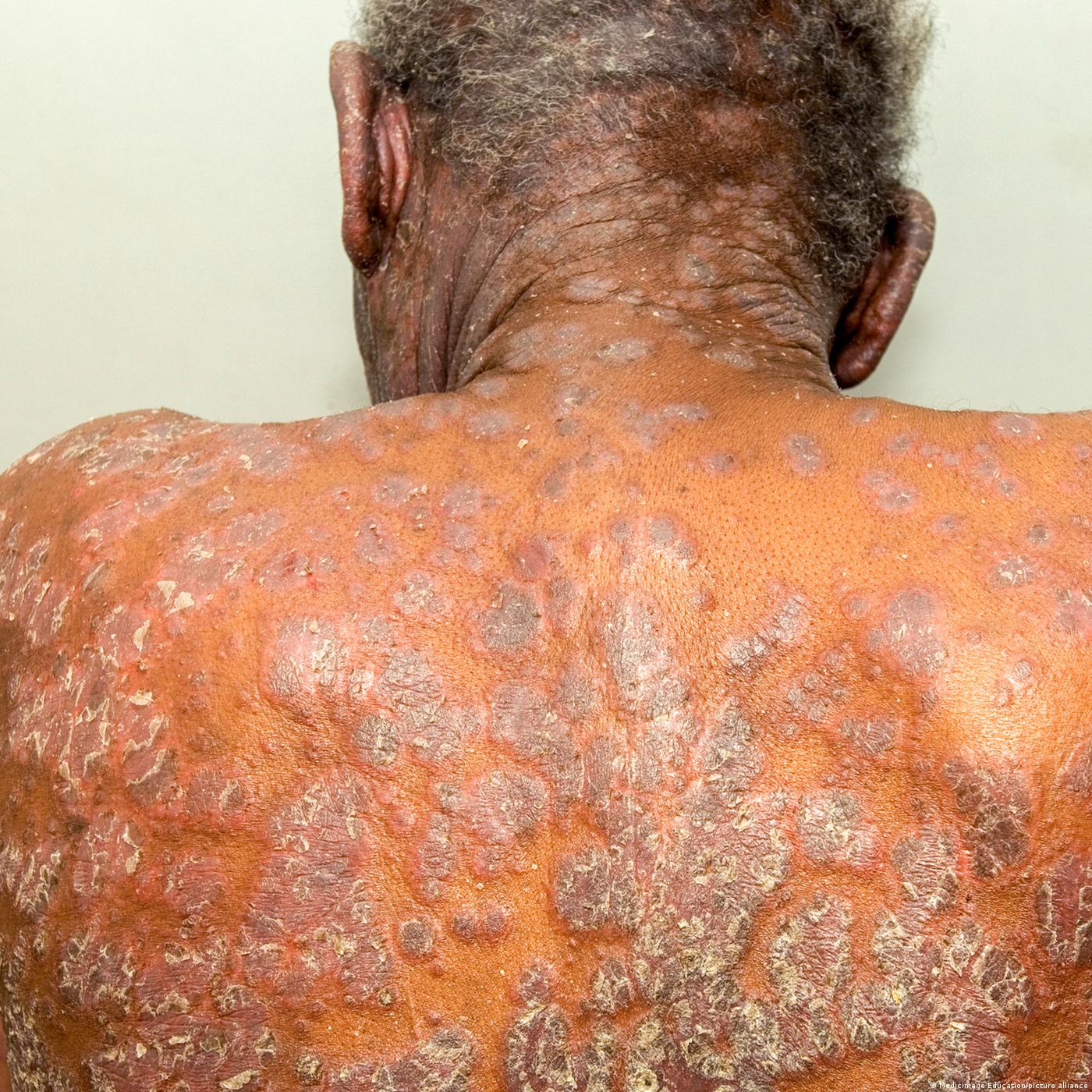 Le psoriasis, plus qu'une simple maladie de la peau