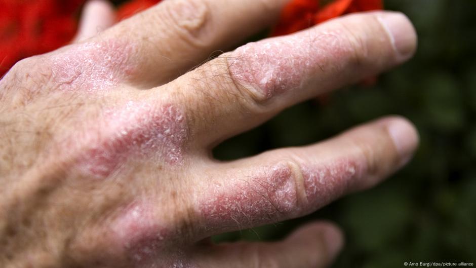 Psorijaza se često razvija na rukama