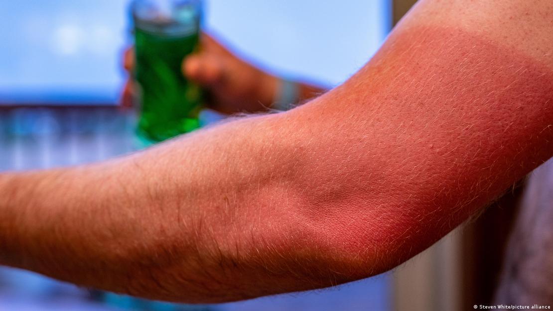 Οι δερματολόγοι λένε πως κάθε ηλιακό έγκαυμα προκαλεί μόνιμη βλάβη στο δέρμα