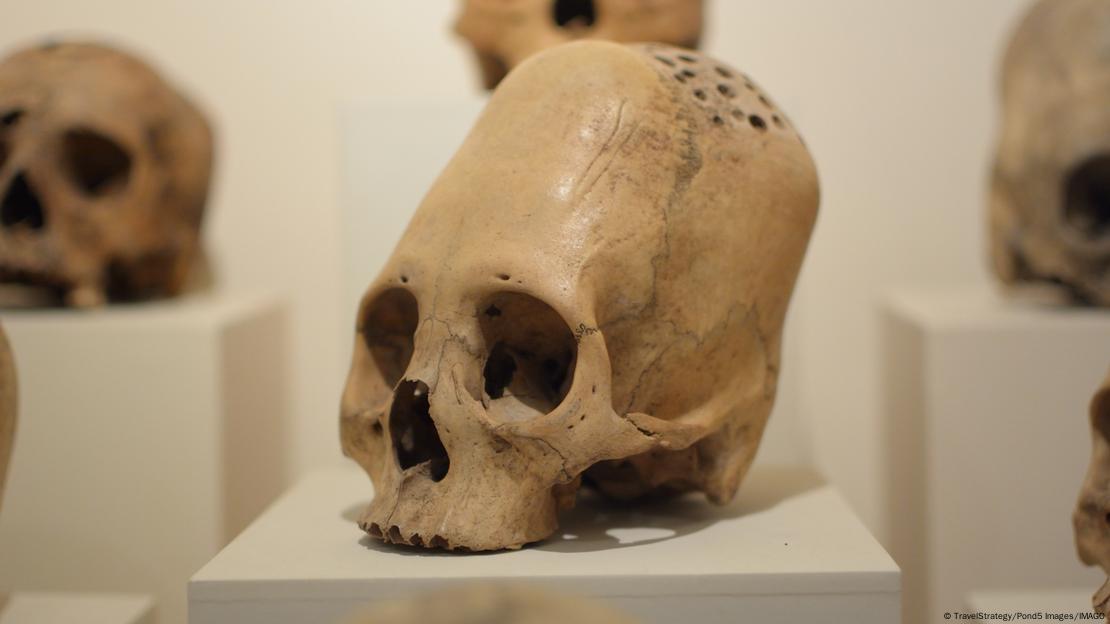 A lo largo de la historia se han descubierto pruebas de deformación craneal artificial en muchos grupos, como la antigua cultura Paracas, en lo que hoy es Perú (foto). A lo largo de la historia se han descubierto pruebas de deformación craneal artificial en muchos grupos, como la antigua cultura Paracas, en lo que hoy es Perú (foto).