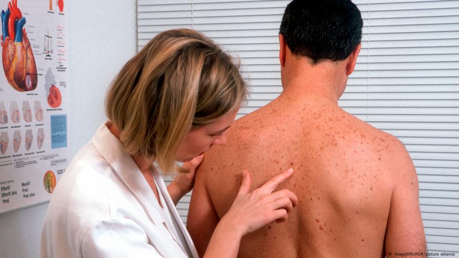 Detecting skin cancer via app – DW – 07/01/2024