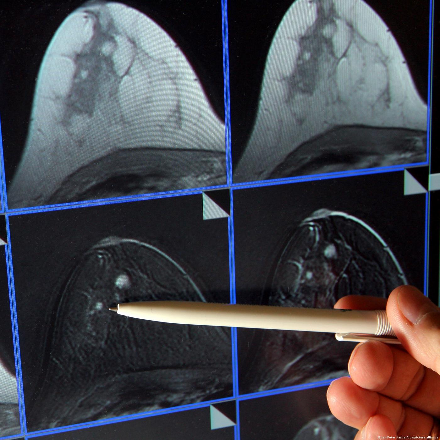 Cancer du sein : dépister tôt pour mieux prendre en charge (2/2)