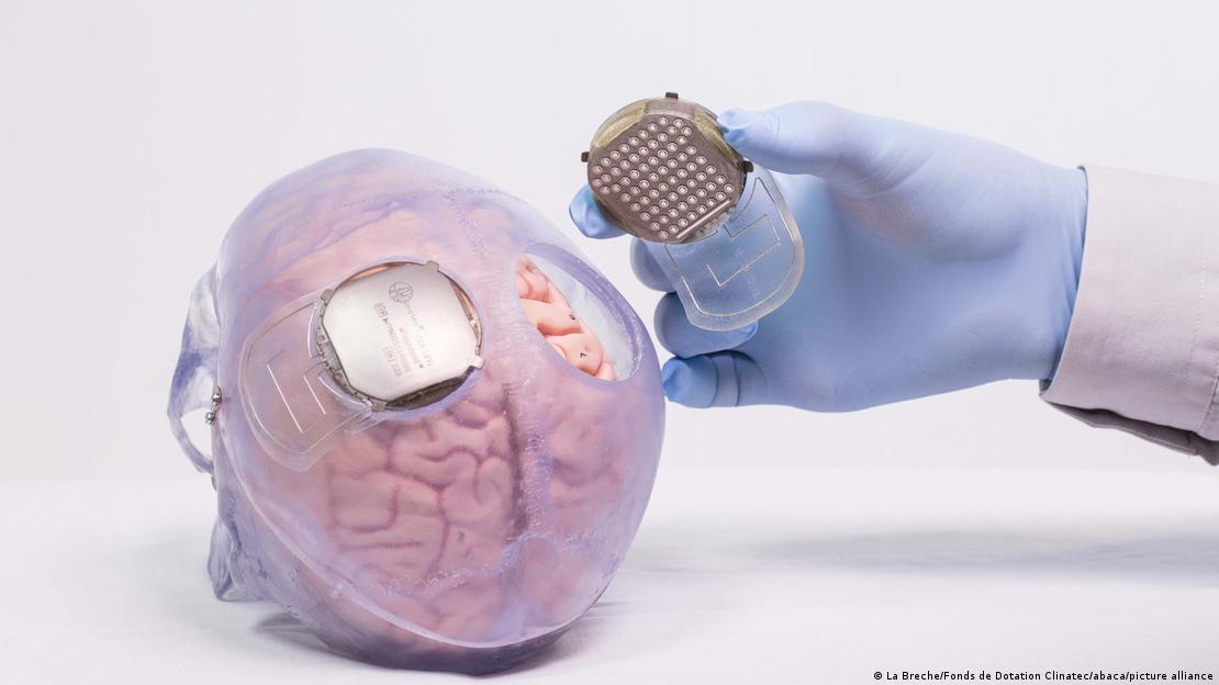 Implante de un chip en el cerebro.
