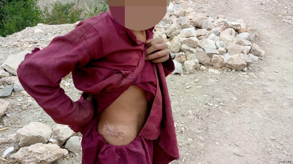 د اچین ولسوالۍ ځايي روغتیايي کارکوونکي هم مني چې د ياد بم تر استعمال وروسته ډېره موده تېره شوې، خو وايي لا هم له یادې سیمې داسې ناروغان ورته راځي چې اثرات یې د کیمیاوي موادو وي. د اچین ولسوالۍ ځايي روغتیايي کارکوونکي هم مني چې د ياد بم تر استعمال وروسته ډېره موده تېره شوې، خو وايي لا هم له یادې سیمې داسې ناروغان ورته راځي چې اثرات یې د کیمیاوي موادو وي.