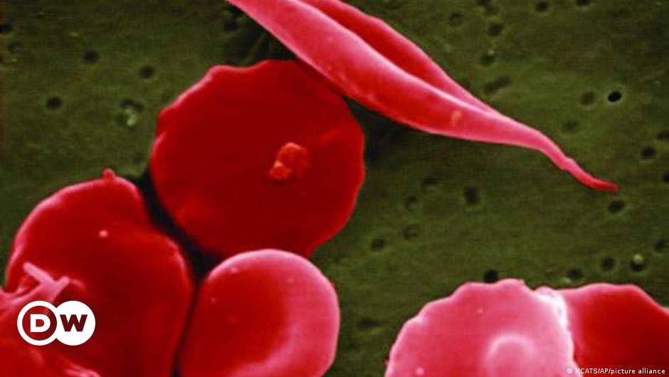 Blutkrankheit Thalassämie jetzt mit Gentherapie behandelbar