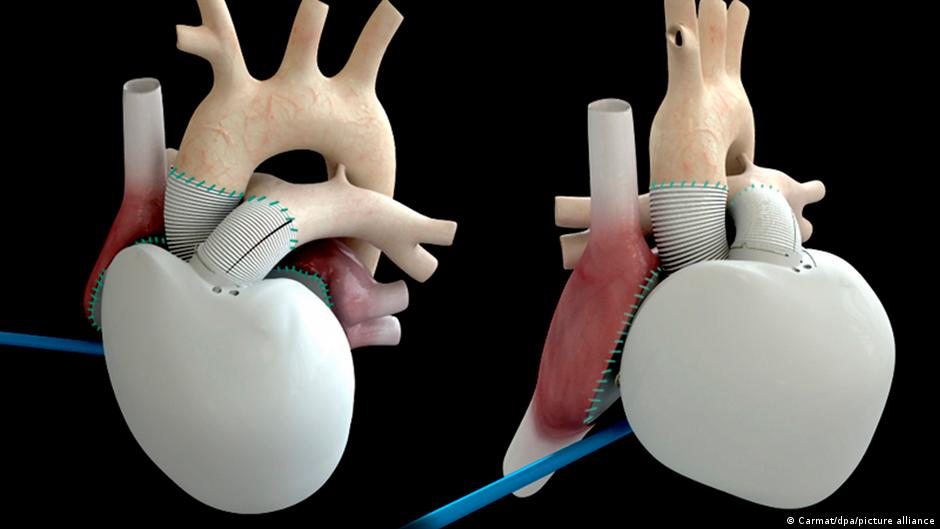 Artificial Hearts a Decade After the First Transplant: Why Haven't They Replaced the Human Heart Yet?