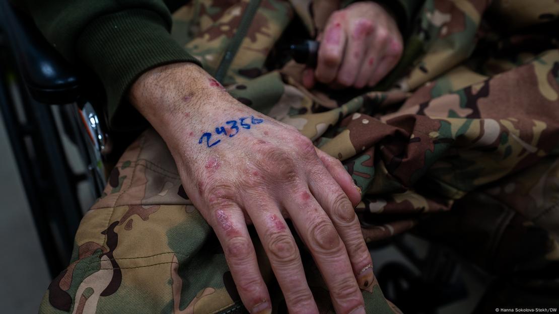 Mão de soldado ferido marcada com número 24.356 em tinta azul