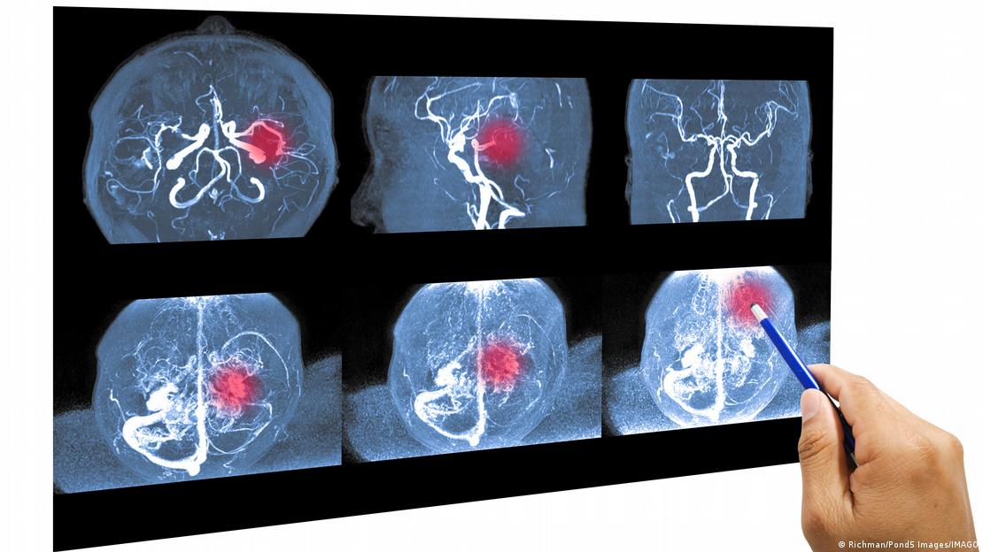 Escaneo del cerebro humano por anormalidades en los vasos sanguíneos 