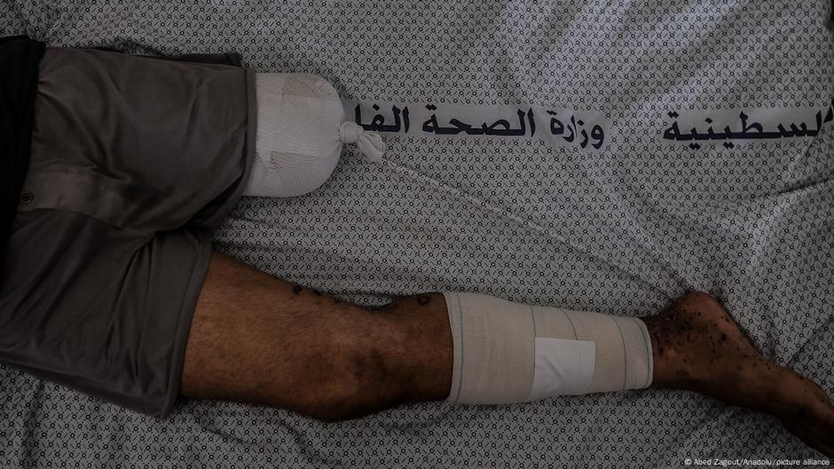 مرضى السرطان ومبتورو الأطراف.. ضحايا منسيون في حرب غزة