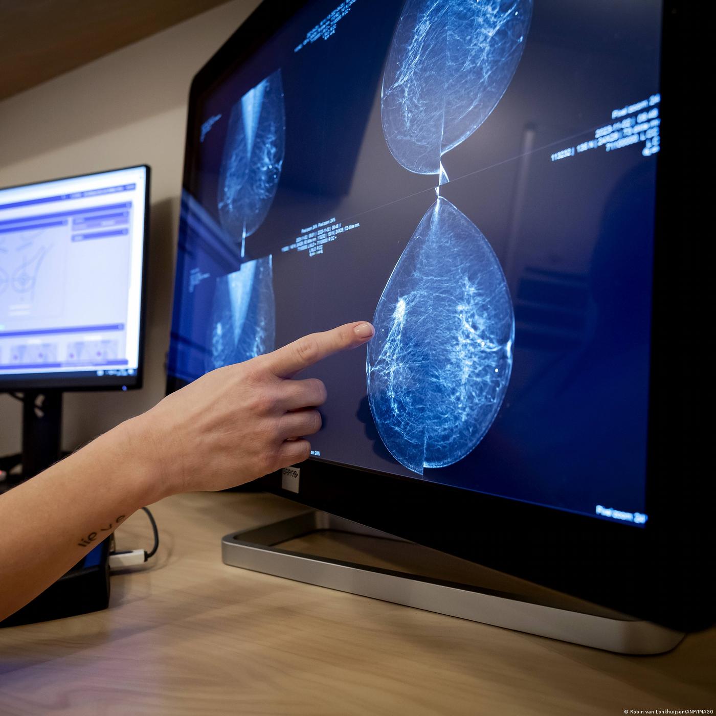 Le dépistage précoce pour lutter contre le cancer du sein