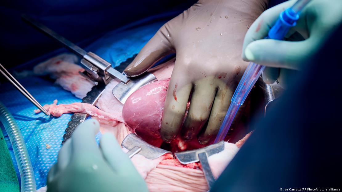 Un cirujano saca el riñón de cerdo modificado genéticamente del abdomen de Lisa Pisano para comprobar su funcionamiento en el hospital de Nueva York el 12 de abril de 2024.