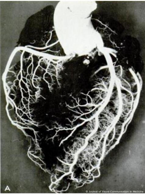 Superficie anterior del corazón tras inyección de Geon Latex 576 y Neopreno 842A. El molde vascular resultante se asemeja a la forma icónica del corazón.