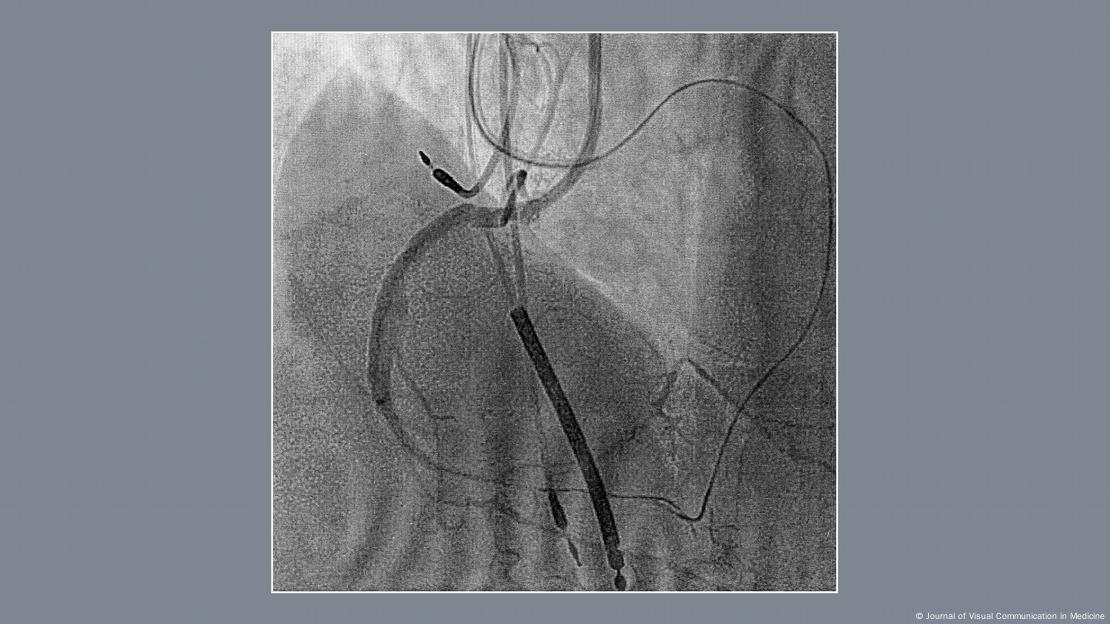 Aparición de la sombra icónica del corazón tras la inyección de contraste en la arteria coronaria derecha y el trayecto del sistema coronario izquierdo mediante un microcatéter en abordaje retrógrado (proyección oblicua anterior izquierda 30°). Estas imágenes, obtenidas en la angiografía coronaria durante la recanalización de una OTC, muestran la forma del "corazón humano". Aparición de la sombra icónica del corazón tras la inyección de contraste en la arteria coronaria derecha y el trayecto del sistema coronario izquierdo mediante un microcatéter en abordaje retrógrado (proyección oblicua anterior izquierda 30°). Estas imágenes, obtenidas en la angiografía coronaria durante la recanalización de una OTC, muestran la forma del "corazón humano".