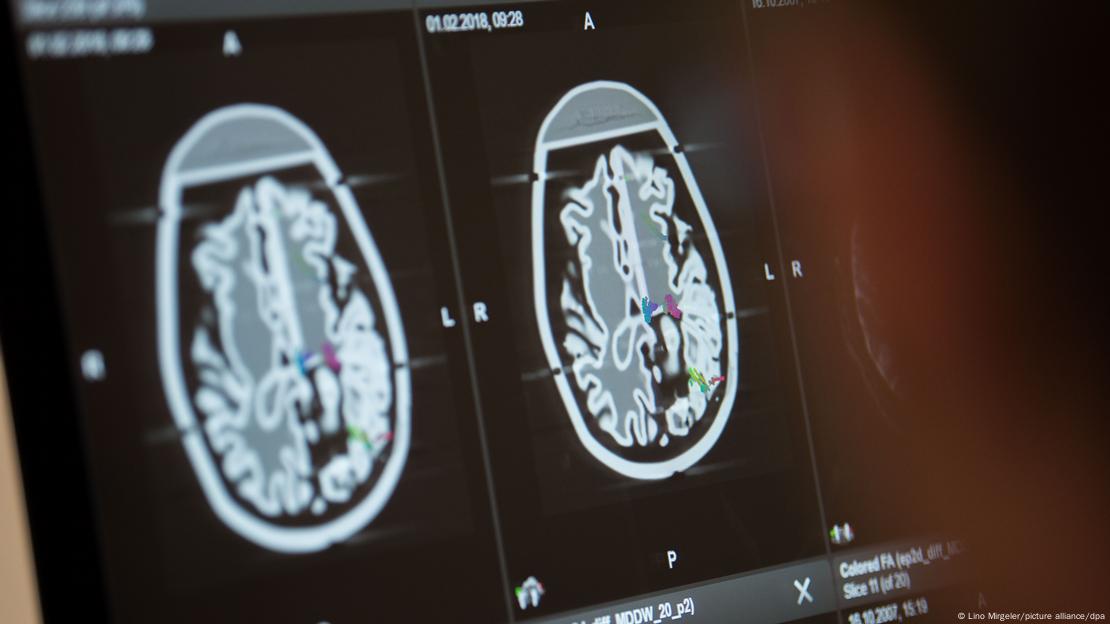 Se la imagen de un escáner cerebral. Se la imagen de un escáner cerebral.