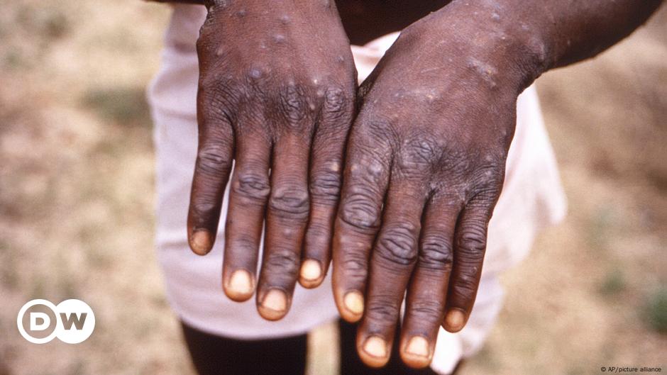 Mpox outbreak declared a public health emergency in Africa DW 08/14