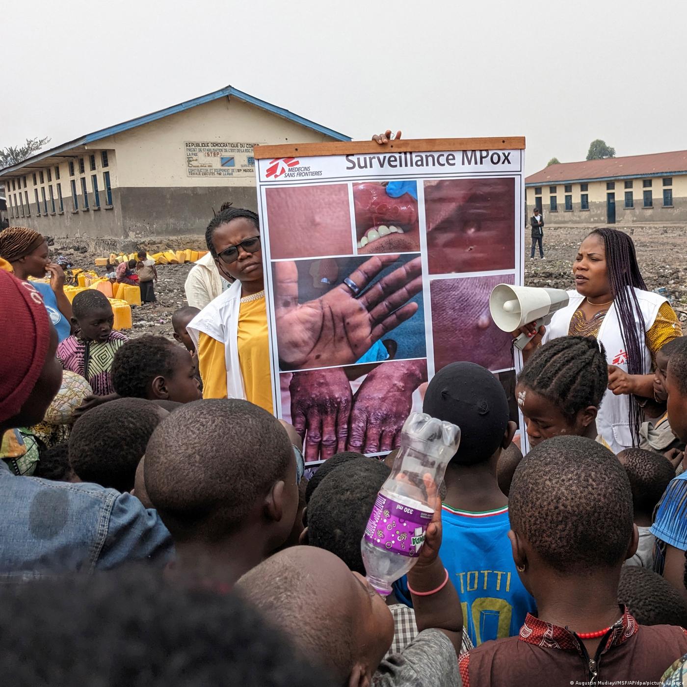 Mpox, des obstacles à la lutte au Burundi