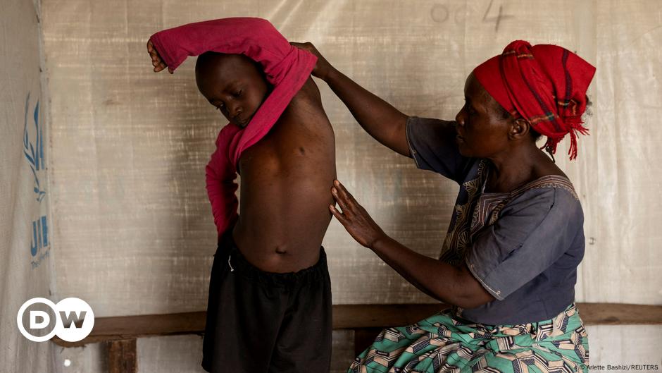 Mpox : la difficile prise en charge des déplacés dans l'est de la RDC